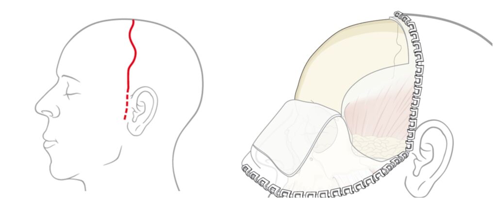 FOTO 3 ACESSO CORONAL Primeira cirurgia de reconstrução facial de alta complexidade é realizada em Guanambi