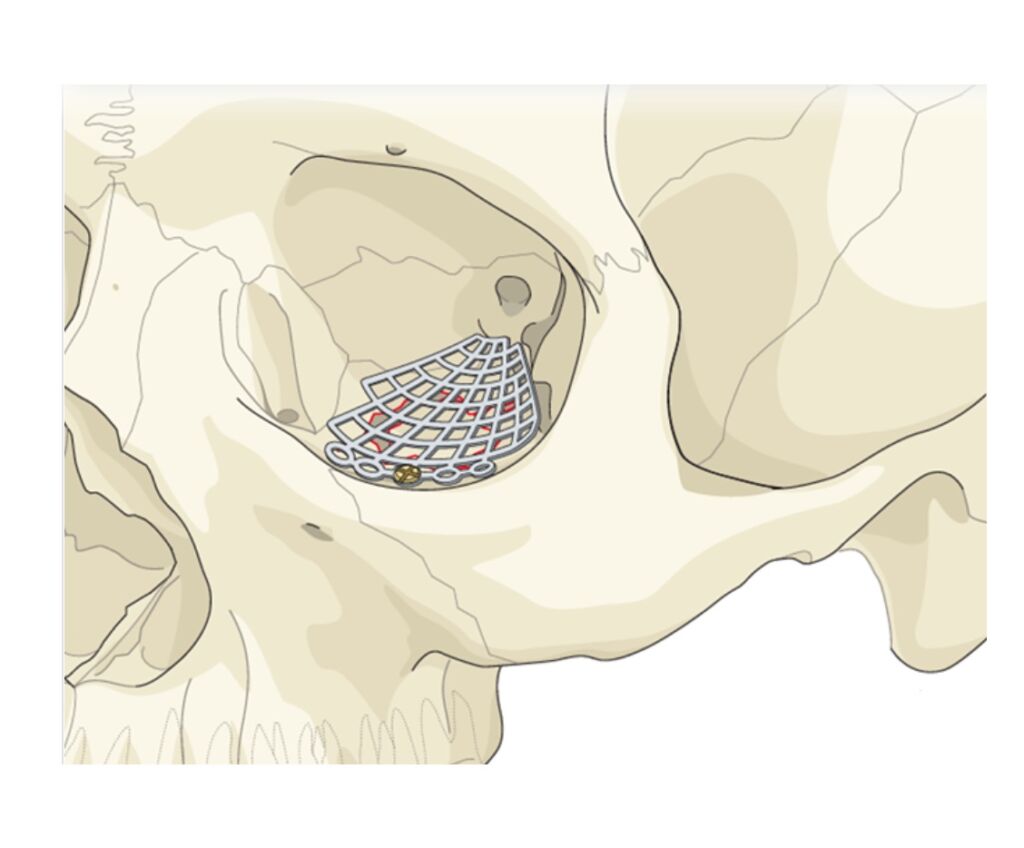 FOTO 4 RECONSTRUCAO DE ORBITA Primeira cirurgia de reconstrução facial de alta complexidade é realizada em Guanambi