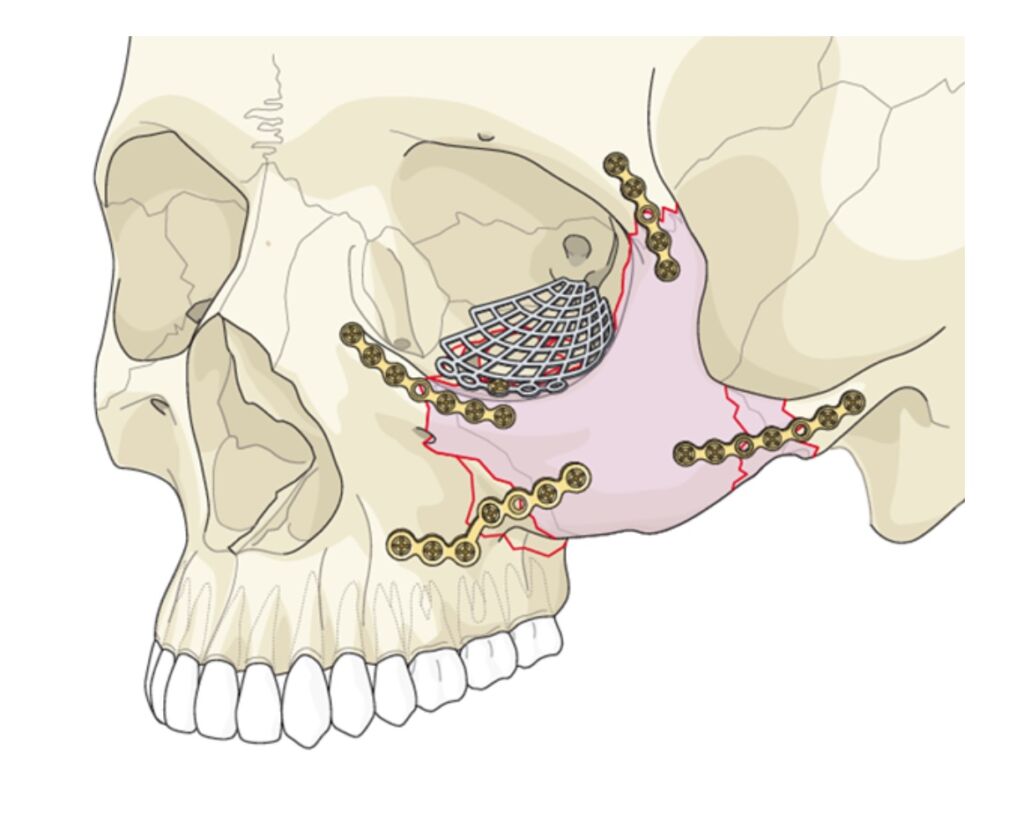 FOTO2 MATERIA 06.04 Dr. Yuri Slusarenko realiza primeira Cirurgia Bucomaxilofacial pelo SUS de Sebastião Laranjeiras